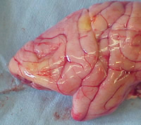 Gross brain, patient 64